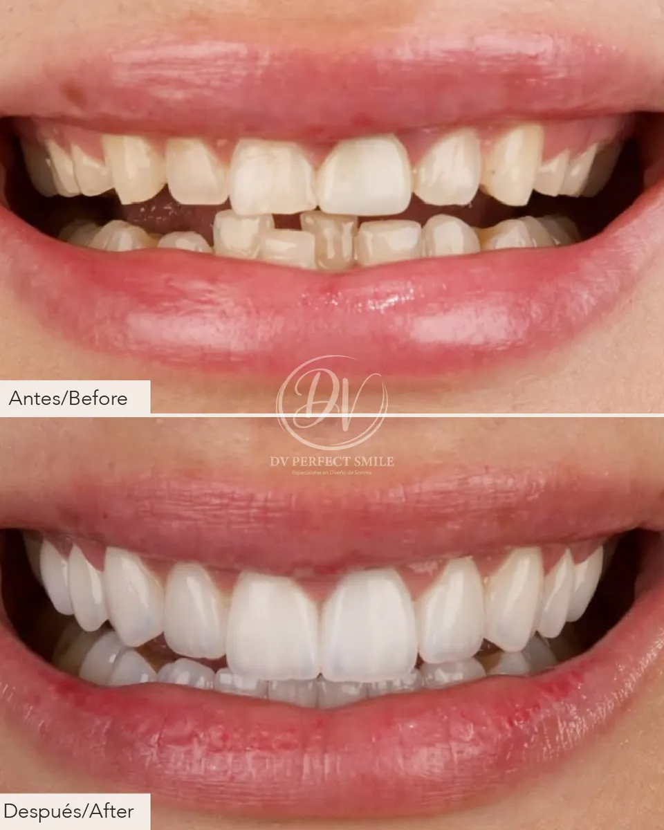 Diseño de Sonrisa Caso 01 – DV Perfect Smile