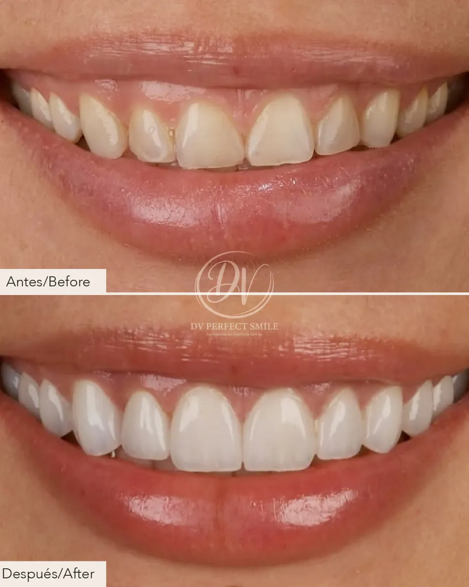 Diseño de Sonrisa Caso 06 – DV Perfect Smile