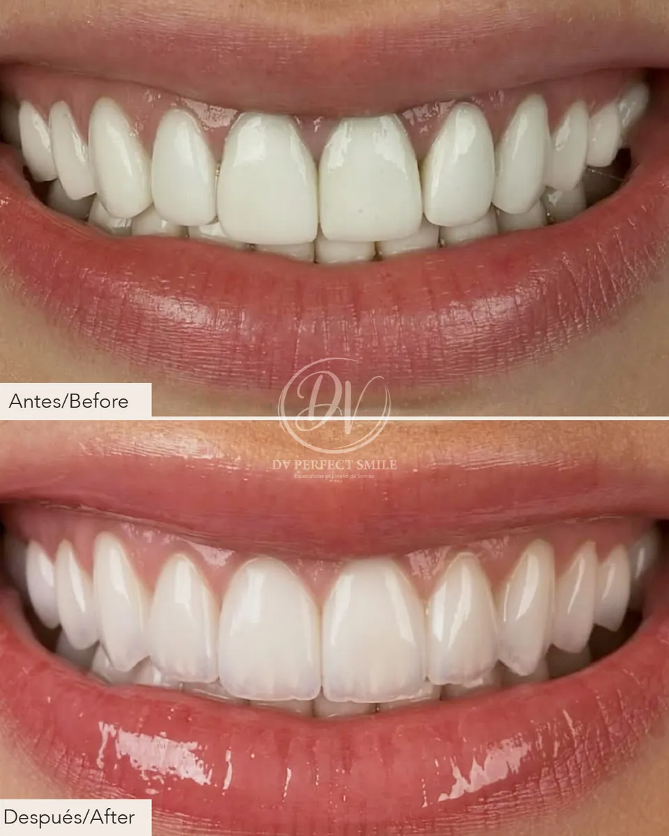Diseño de Sonrisa Caso 04 – DV Perfect Smile