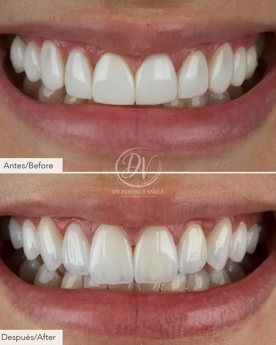 Diseño de Sonrisa Caso 02 – DV Perfect Smile