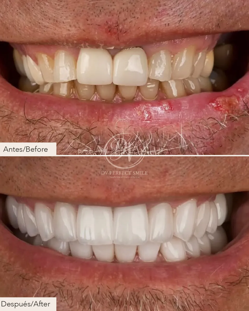 Diseño de Sonrisa Caso 03 – DV Perfect Smile