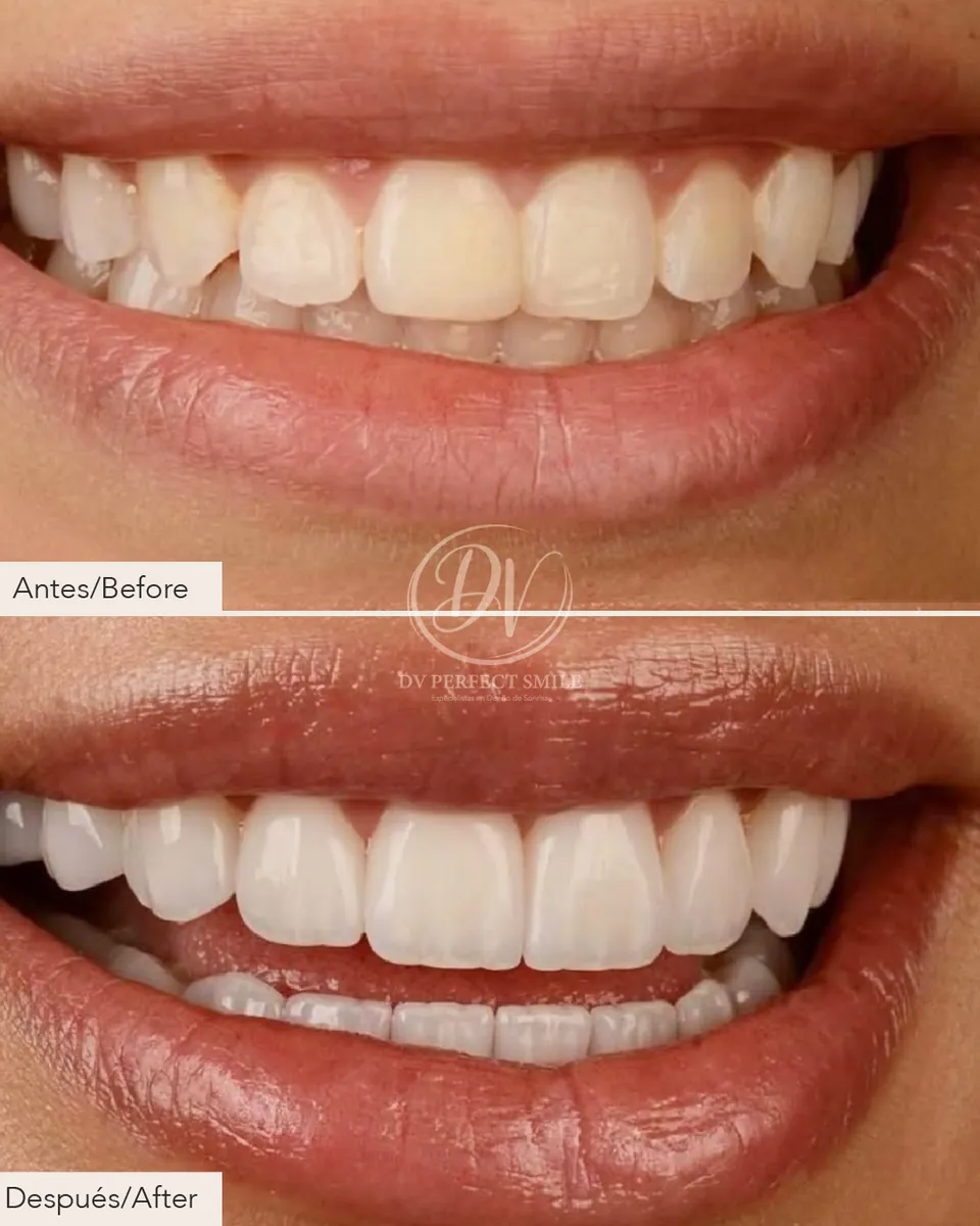 Diseño de Sonrisa Caso 05 – DV Perfect Smile